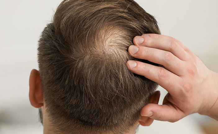 alopecia-mobile